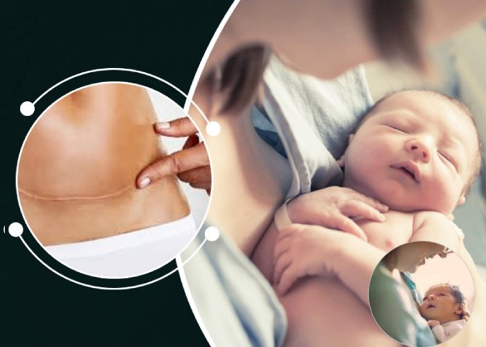 Cesarean Delivery